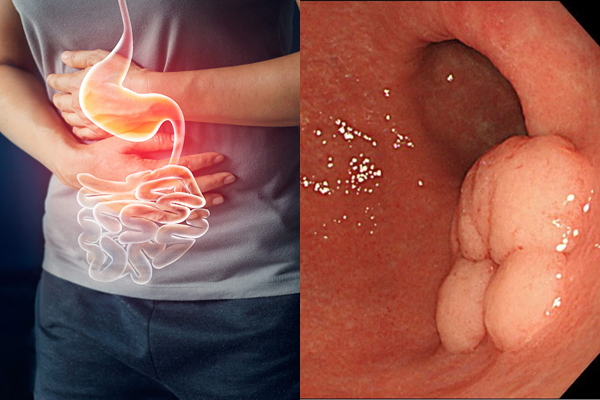 Ung thư dạ dày – Nguyên nhân, triệu chứng và hướng điều trị hiện nay